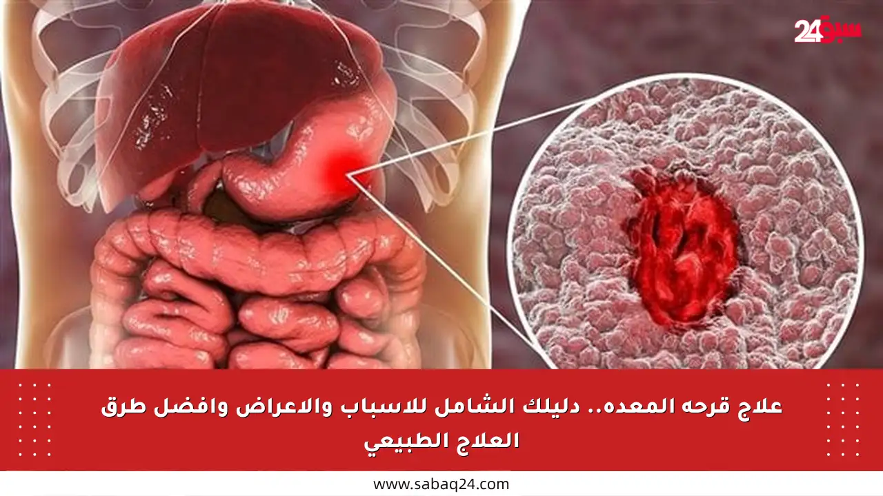 علاج قرحة المعدة.. دليلك الشامل للأسباب والأعراض وأفضل طرق العلاج الطبيعي